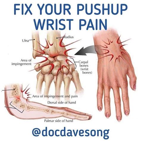 Pin On Wrist Pain Relief