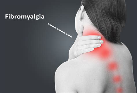 Fibromyalgia Causes Symptoms And Treatment Bonati