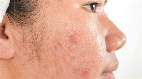 5 Types Of Acne Scars And How To Treat Them