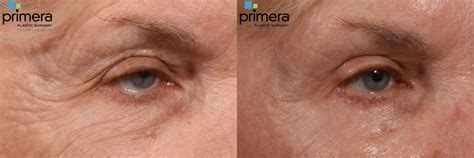 Co2 Laser Skin Resurfacing With Upper Eyelid Lift