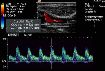 Ultrasound Assessment Of Carotid Arterial Atherosclerotic Disease