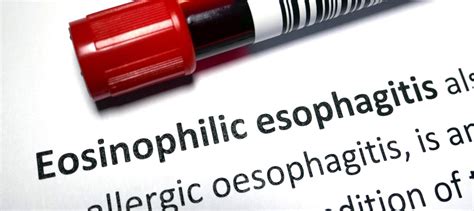 Eosinophilic Esophagitis Eoe Symptoms Causes And Treatment Dr Drew