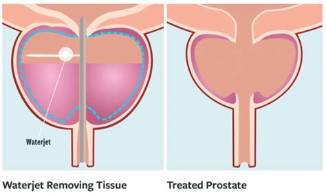 Aquablation Therapy The Urology Partnership