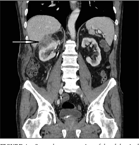 Figure 1 From Achromobacter Denitrificans Renal Abscess Semantic Scholar