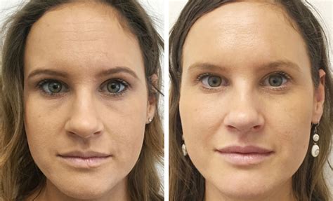 Full Face Rejuvenation The Cosmetic Studio Noosa