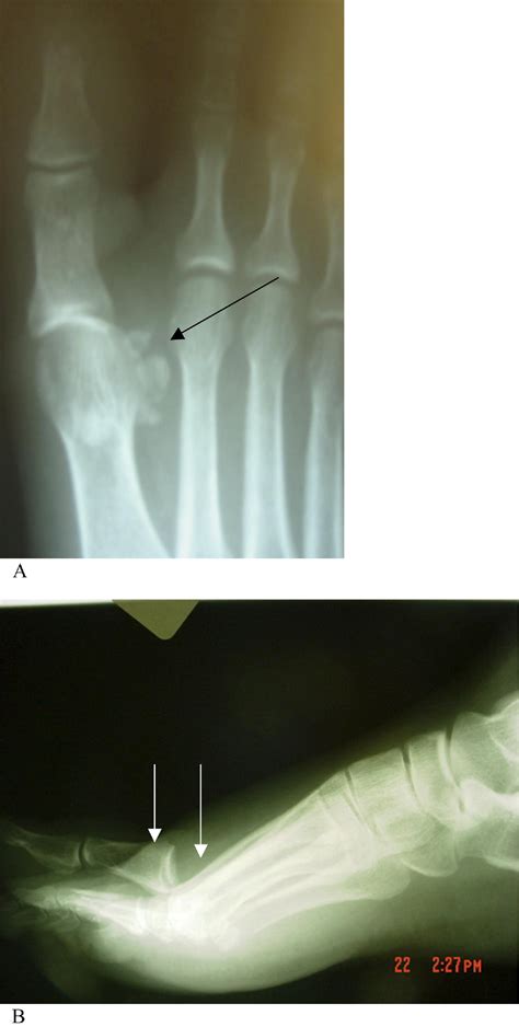 First Metatarsophalangeal Joint Dislocation With Open Fracture Of