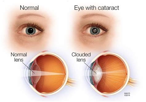 Cataract Surgery At Lakeland Surgical Diagnostic Center Lakeland