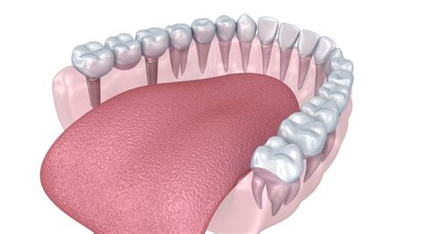 Download or buy, then render or print from the shops or marketplaces. Lower teeth crown and dental implant 3D Model in Anatomy ...