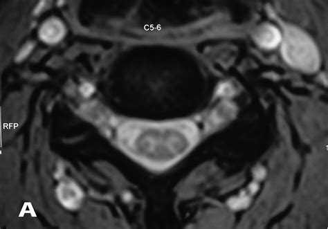 Complete Manuscript Title Symptomatic Bilateral Cervical Perineural