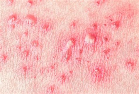 Natural Remedies For Shingles Causes And Symptoms Of Shingles