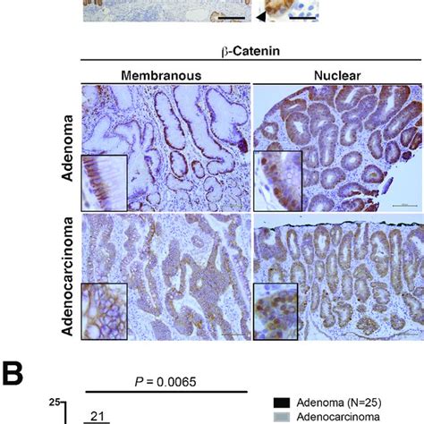 The Visualization Of Sporadic Adenoma And Adenocarcinoma Pathogenesis