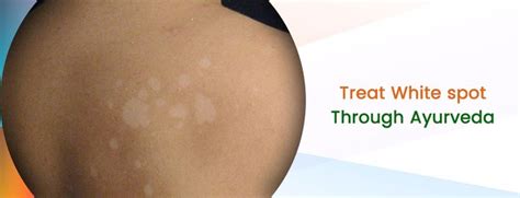 Treat White Spot On Skin Through Ayurveda White Spots On The Skin Are
