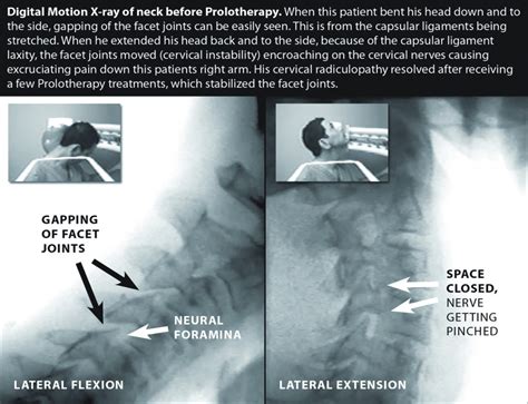 Cervical Spine Instability Getting A Correct Diagnosis With Digital