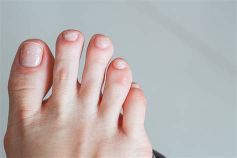 Causes Of White Spots On Your Toenails My Footdr