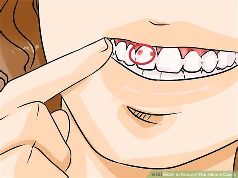 Cavities are small holes in your teeth that usually worsen over time. How to know if u have a cavity, MISHKANET.COM