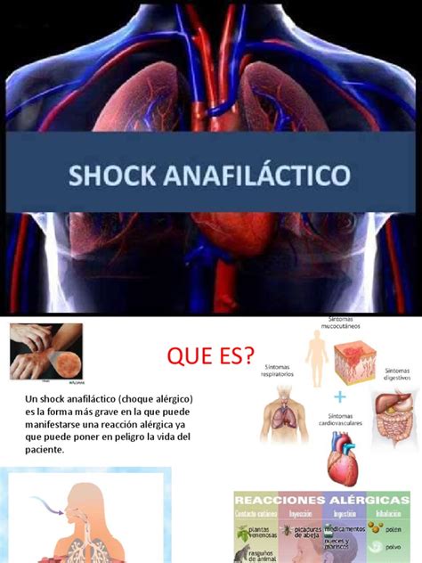 Una Perspectiva General Sobre El Shock Anafiláctico Causas Síntomas