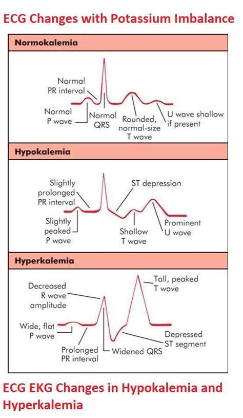 ECG EKG Changes In Hypokalemia And Hyperkalemia ECG Should Be Done On