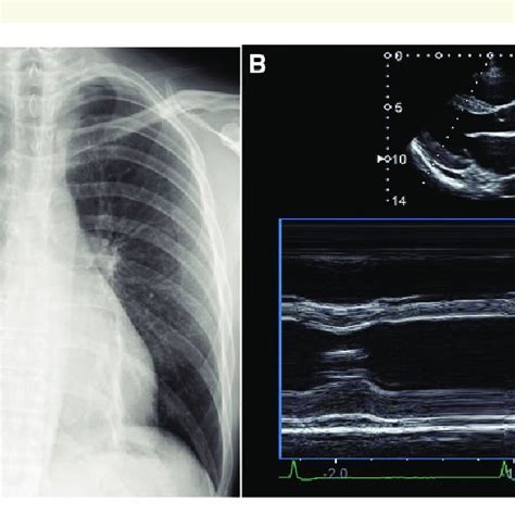 Chest X Ray Showing Mild Cardiomegaly And Pulmonary Congestion A An