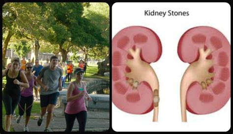 Give you more energy make you feel stronger improve your. Get Rid Of Kidney Stones with Exercise
