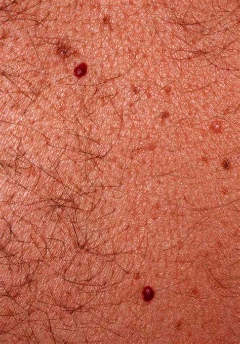 Cherry Angioma Cherry Hemangioma Senile Angioma Campbell De Morgan Spot Dermatology Advisor