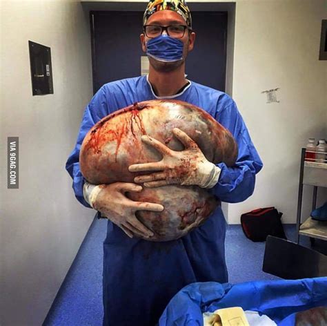 Ovarian Cyst Removed By This Doctor And Hes Hugging It Like Its A New