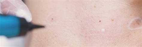Cryotherapy Lesions And Skin Tag Removal Treatments In Melbourne Vic