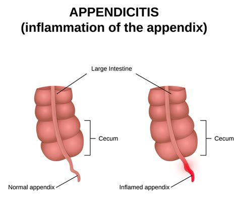 What Causes Appendicitis Appendicitis Symptoms