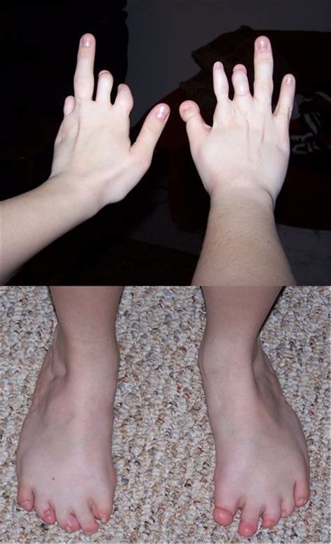 Amniotic Band Syndrome Toes