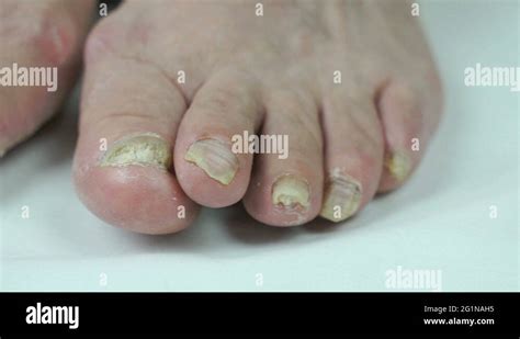 Onychomycosis Fungal Infection Of Toenails Stock Video Footage Alamy
