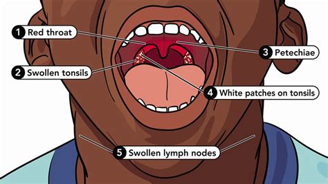 Strep Throat All You Need To Know Cdc