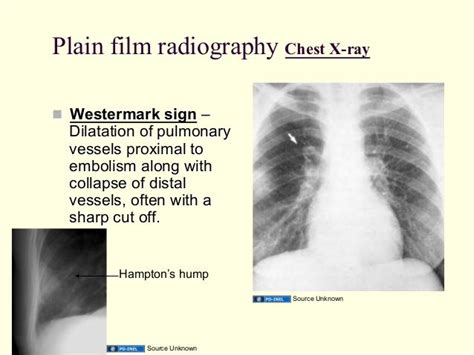 Westermark Sign Radiology Thorax Pinterest