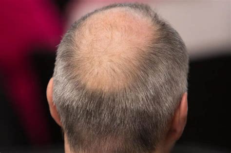 Flipboard Scientists Discover Critical Breakthrough In Cure For Baldness