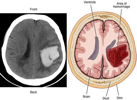 Brain Bleedhemorrhage Intracranial Hemorrhage Causes