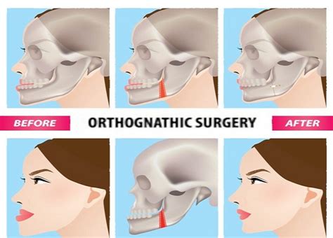 Check Out The Various Types Of Orthognathic Surgeries