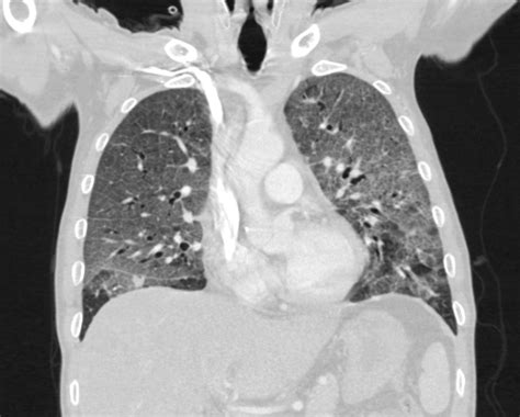 Pneumocystis Pneumonia Image