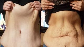 Weight Loss And Loose Skin Patients Forgotten By Nhs Bbc News