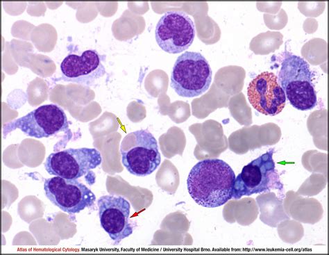 Plasma Cell Myeloma Cell Atlas Of Haematological Cytology