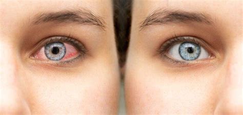 Sindrome Occhio Secco Cos Cause Sintomi E Cure