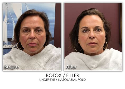Botox And Dysport Archives Skin Rejuvenation Clinic Skin Rejuvenation