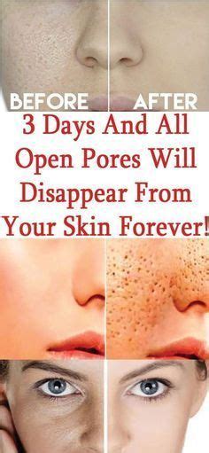 Pin By Pooja Mittal On Acne Skin Skin Big Pores Skin Care Tips