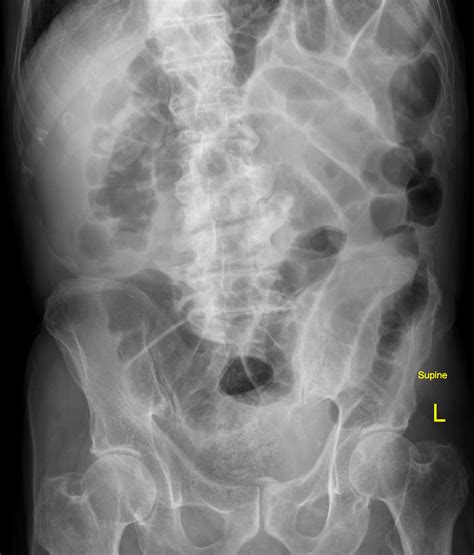 Small Bowel Obstruction Due To An Incarcerated Right Inguinal Hernia