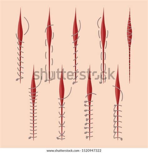 Series Different Medical Stitches Isolated On Stock Vector Royalty