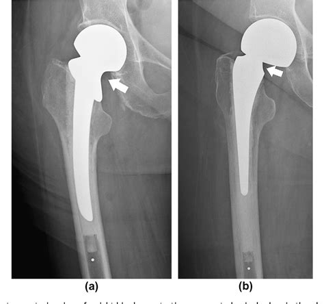 Figure 1 From Hip Arthroplasty Part 1 Prosthesis Terminology And