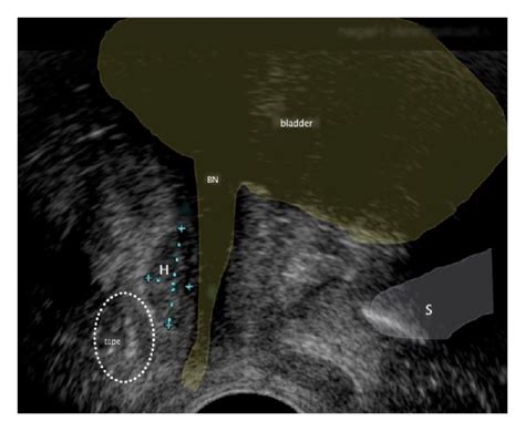 Pelvic Floor Ultrasound Examination In Sagittal Plane A Small Hematoma