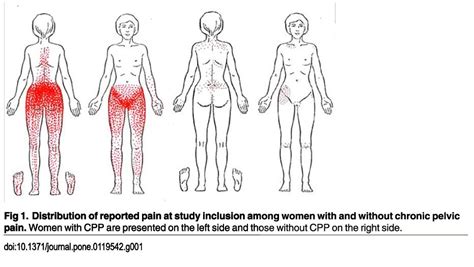 Chronic Pelvic Pain Demystifying Referred Pain Foundational Concepts