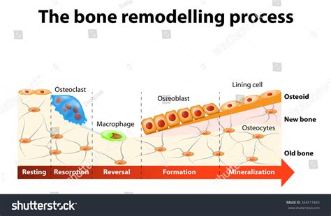The Bone Remodeling Process Involves The Following Steps In A Healthy