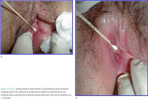 Cervix With Speculum And Clover Vaginal Speculum Exam Photos Telegraph