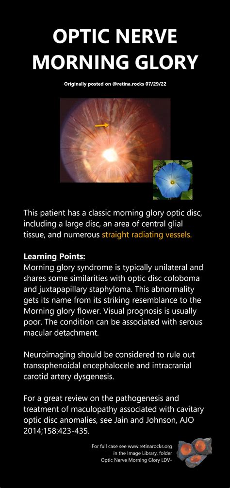 Optic Nerve Disorders Morning Glory Syndrome Retina Rocks