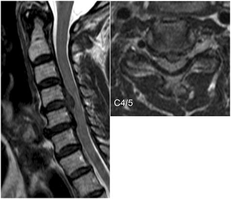 Preoperative MR Image Of A Patient With Cervical Spondylotic Myelopathy