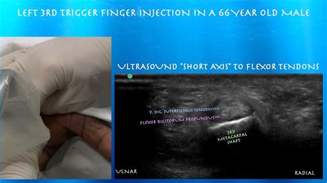 Ultrasound Guided Trigger Finger Injection By Youtube